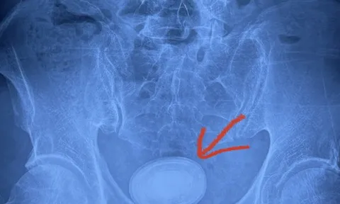 Người đàn ông có viên sỏi kích thước 6cm trong bàng quang