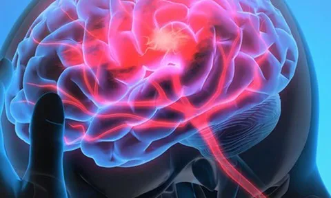 Nghiên cứu khoa học chỉ ra ‘thủ phạm’ hàng đầu của loại đột quỵ đang gia tăng ở người trẻ
