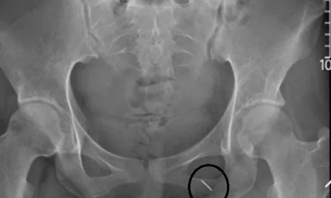 Phòng thượng mã phong cho chú rể, cô dâu bị kim đâm xuyên mông