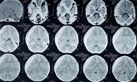 Bé gái bị chấn thương sọ não do ngã đập đầu xuống nền sân trường