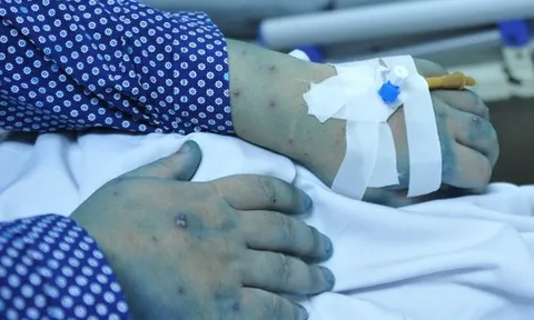 5 biến chứng nguy hiểm của bệnh thủy đậu, có thể gây tử vong nhưng ít người biết