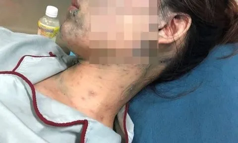 Mắc thủy đậu bội nhiễm, thai phụ 22 tuần phải nhập viện khẩn