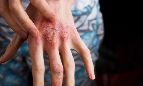 Không chịu tẩy giun suốt nhiều năm, người đàn ông mắc bệnh hiếm gặp