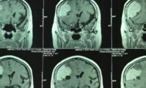 Đi khám đau đầu, phát hiện khối u màng não to hơn trứng vịt