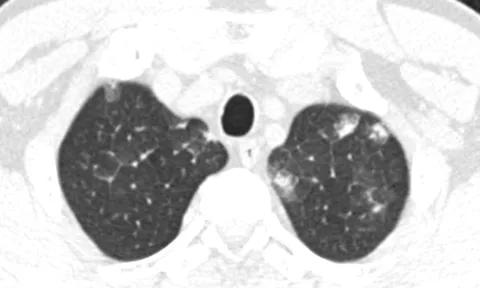 Không tẩy giun nhiều năm, người đàn ông bị sốt, tức ngực do mắc hội chứng ít ai biết