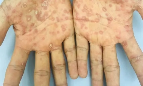 Dấu hiệu nhận biết giang mai ác tính