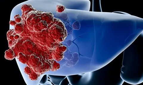 Đau 3 vùng này, coi chừng ung thư gan