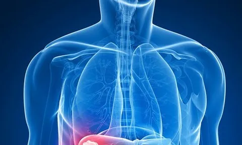 Đau tức hạ sườn bên phải, coi chừng u gan ác tính