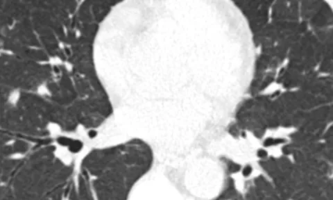 Điều trị thành công một ca bệnh hiếm gặp - ấu trùng giun di trú qua phổi