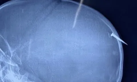 Phẫu thuật kịp thời cho bé trai bị cây đinh dài 3cm đâm qua xương sọ