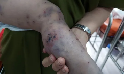 TP HCM: Một ca tử vong vì bệnh tay chân miệng