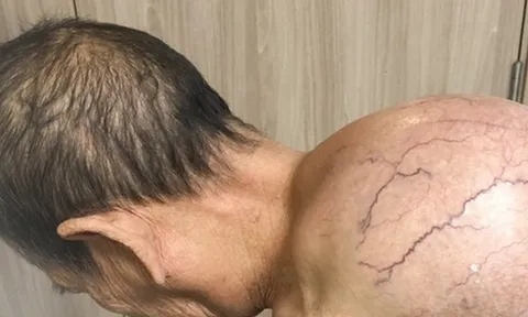 Phẫu thuật cắt bỏ thành công khối u 'khổng lồ' trên lưng cụ bà 95 tuổi