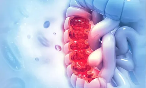 Ung thư ruột tăng 2,6 lần ở thanh thiếu niên: Lầm tưởng nguy hiểm