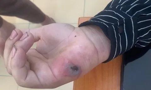 Điện Biên phát hiện 3 ổ dịch bệnh than trên người, Bộ Y tế vào cuộc