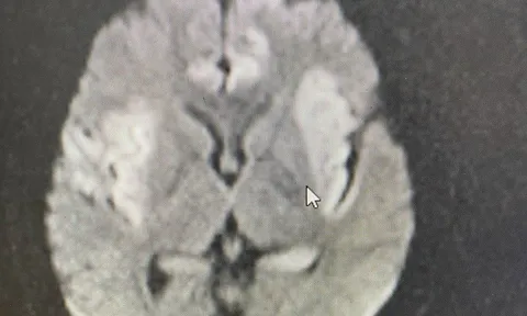 Viêm não virus - đừng chủ quan