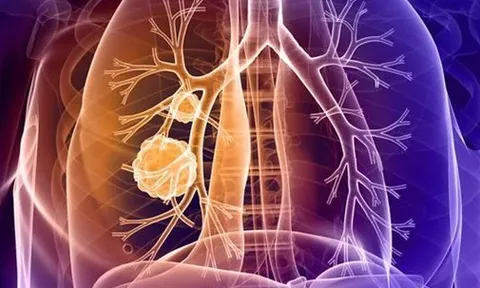 2 vị trí đau bất thường cảnh báo ung thư phổi nhưng dễ bị bỏ qua