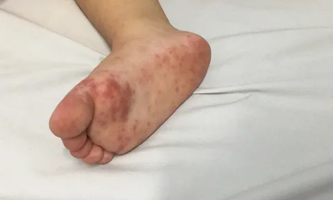 Làm sao sớm nhận biết trẻ mắc tay chân miệng độ nặng?