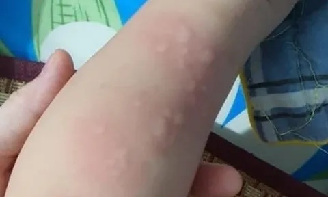 Mẹ run rẩy phát hiện con 15 tháng tuổi nhiễm giun đũa chó và giun lươn