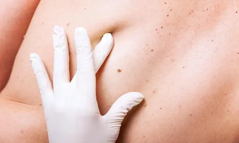 LƯU Ý: 5 bước tự phát hiện ung thư da