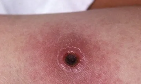 Phát hiện bé gái 2 tuổi mắc bệnh than không rõ nguồn lây