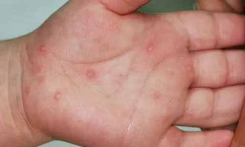 Ghi nhận gần 9.000 ca tay chân miệng, 3 trẻ em tử vong