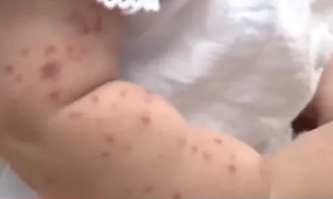 TP. Hồ Chí Minh: Xác định nguyên nhân gây bệnh tay chân miệng nặng ở trẻ em