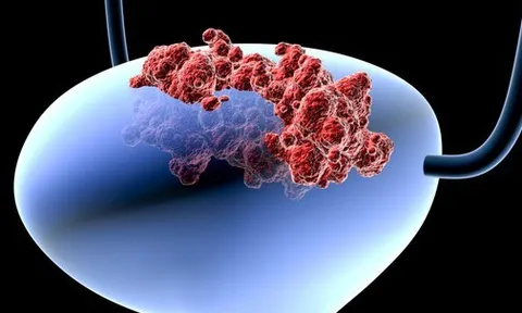 2 triệu chứng phổ biến nhất của ung thư bàng quang, có 1 cũng cần đi khám ngay