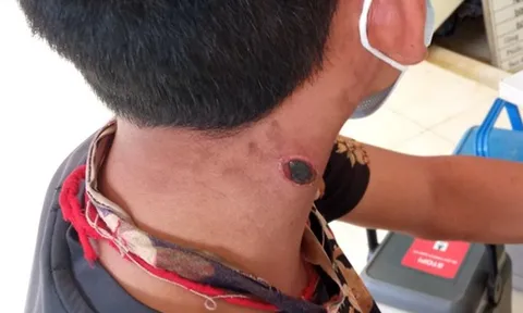 Khẩn trương ngăn chặn bệnh than