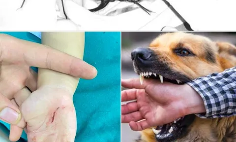 Bé 18 tháng tuổi bị chó cắn lộ xương sọ