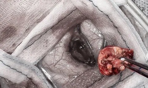 Mổ não bệnh nhân đột quỵ, lấy được khối u hiểm