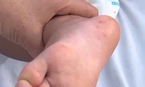 TP Hồ Chí Minh: Bệnh tay chân miệng tăng 133% trong một tuần