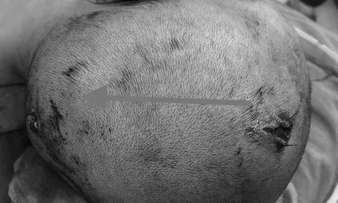 Bình ga mini trong đống rác phát nổ khiến bé gái hôn mê