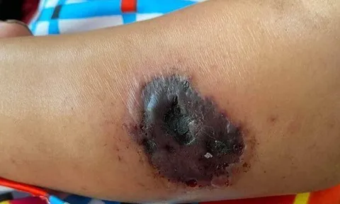 Nguy cơ lây lan bệnh than từ gia súc: Bác sĩ chỉ cách phòng tránh