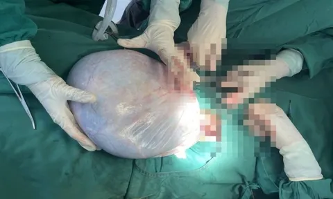 Phẫu thuật cắt khối u buồng trứng nặng gần 9kg cho bé gái 15 tuổi
