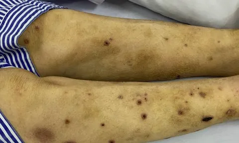 Mời thầy lang dùng ong châm trị đau chân tay, bệnh nhân đái tháo đường phải nhập viện vì đa biến chứng