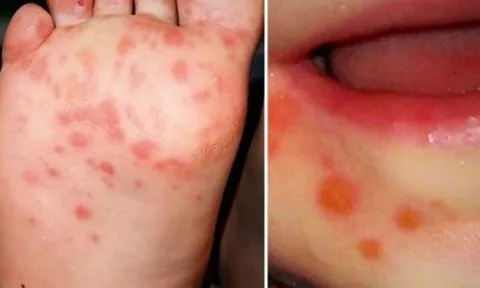 Tp.HCM: Đã có 4 ca tử vong do tay chân miệng