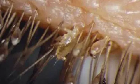 Mắt đỏ, ngứa, khó chịu, đi khám phát hiện 100 'thủ phạm' đáng sợ ở mi mắt