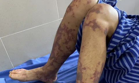 Người đàn ông nguy kịch do nhiễm liên cầu lợn từ thói quen ăn tiết canh