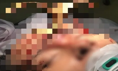 Rút thanh sắt cắm giữa trán, cứu sống người đàn ông đang nguy kịch