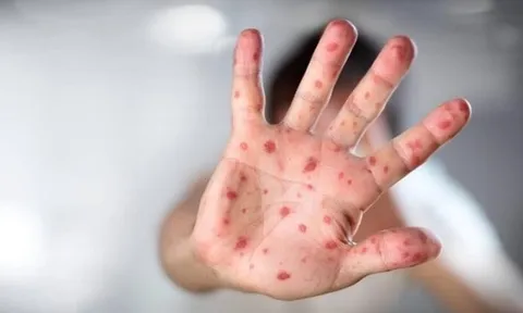 5 dấu hiệu tay chân miệng chuyển nặng