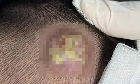 Thường xuyên ngủ chung với chó, mèo, 2 thành viên trong gia đình bị bệnh lạ ở vùng da đầu