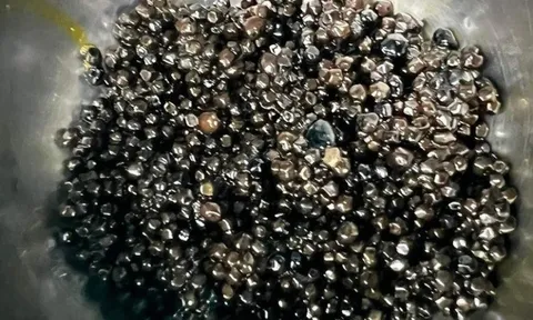 Cụ bà 73 tuổi có hàng nghìn viên sỏi trong túi mật