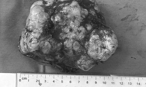 Đi mổ ruột thừa, phát hiện khối u ác tính "khủng" làm xẹp phổi trái