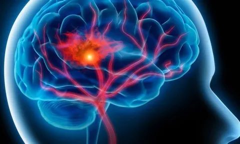 Tập thể dục rất dễ gây đột quỵ ở người mắc bệnh này: Những dấu hiệu đột quỵ nhất định phải biết