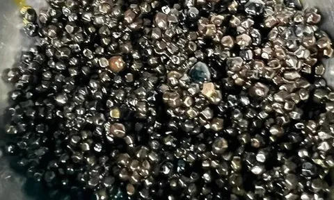 Đau bụng đi khám, người phụ nữ có hàng nghìn viên sỏi mật: Dấu hiệu cảnh báo là gì?