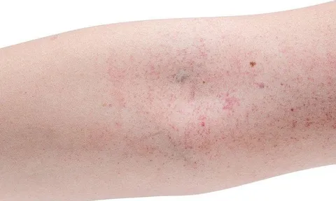 Ho do sốt xuất huyết: Chớ chủ quan