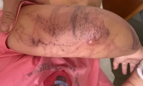 Bị sứa đốt khi tắm biển, bé 7 tuổi nhập viện trong tình trạng mất ý thức