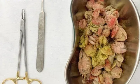 Bé gái nguy kịch vì ăn nửa con gấu bông