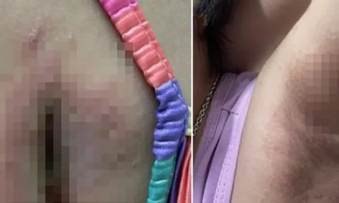 Loại côn trùng có nọc độc gấp 12-15 lần rắn hổ mang khiến bé gái 8 tuổi nhập viện