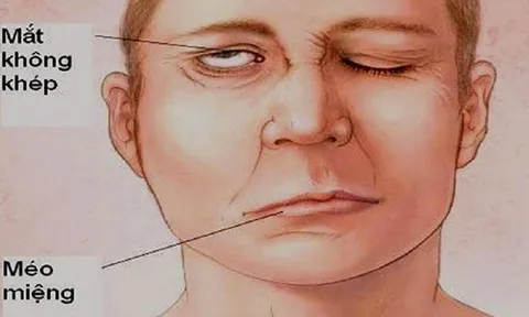 Miệng méo, mắt không nhắm kín do tắm ngay khi tập thể dục buổi sáng